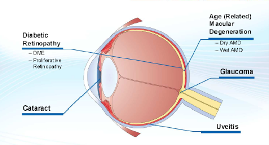 Ophthalmic Implant Review